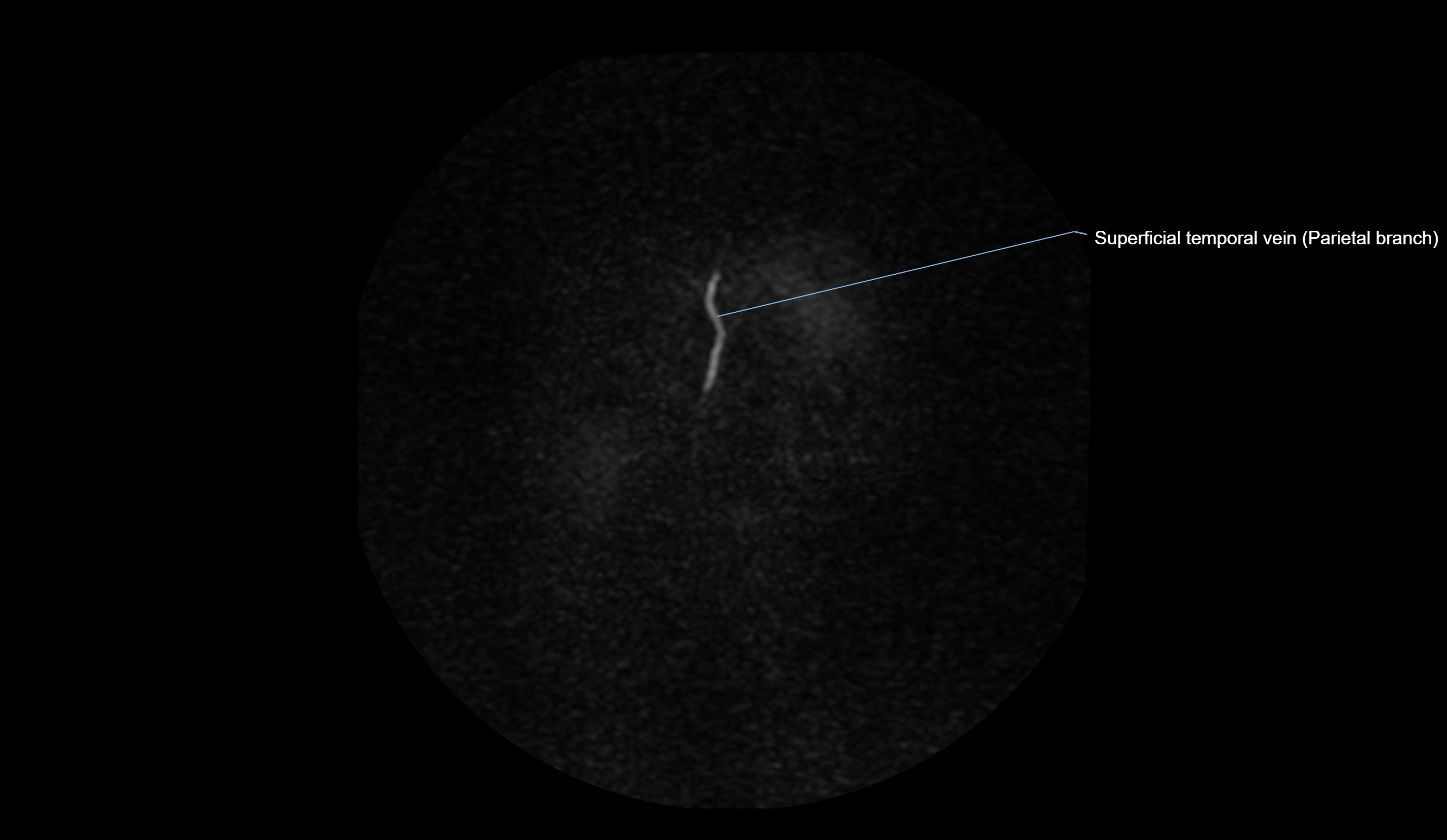 MRV brain sagittal anatomy 3T MRI labelledimages -00007.webp